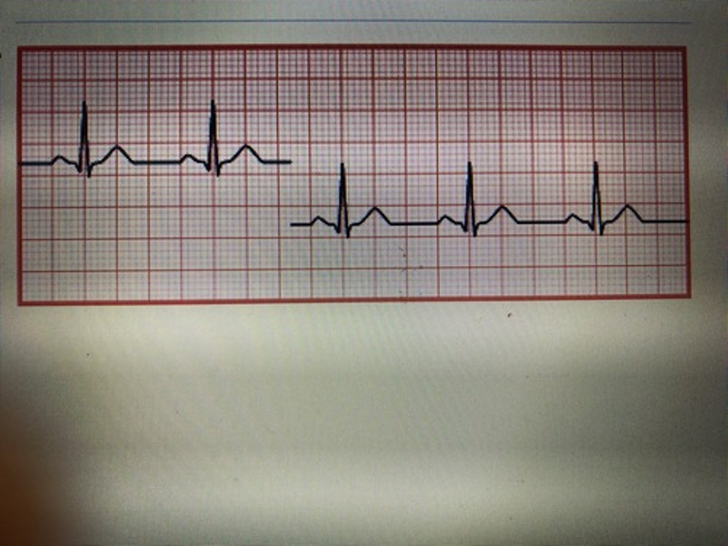 <p>break in the baseline or a fully nonrecorded lead can be noted caused by broken wires or disconnected leads</p>