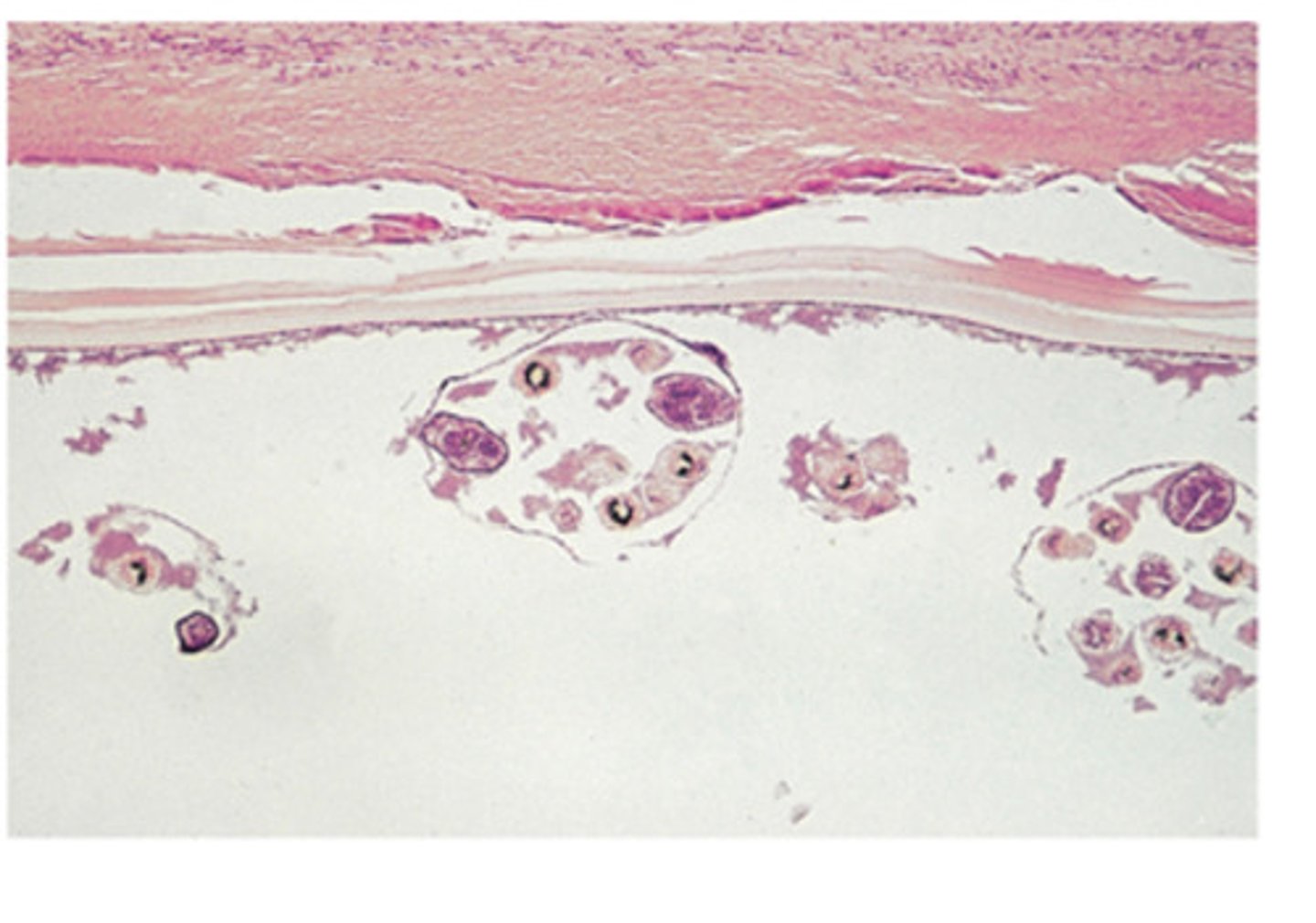 <p>The unilocular hydatid cyst is produced in the intermediate host by the tapeworm:</p>