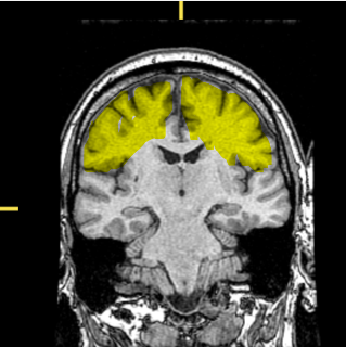 <p>What lobe of the brain is highlighted?</p>