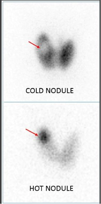<p>Cold</p><p>—Diminished uptake, photopenia: refer to areas of abnormally low concentration of radiopharmaceutical </p><p>Hot</p><p>—Increased uptake, increased activity: refer to areas of abnormally high concentration of radiopharmaceutical </p>