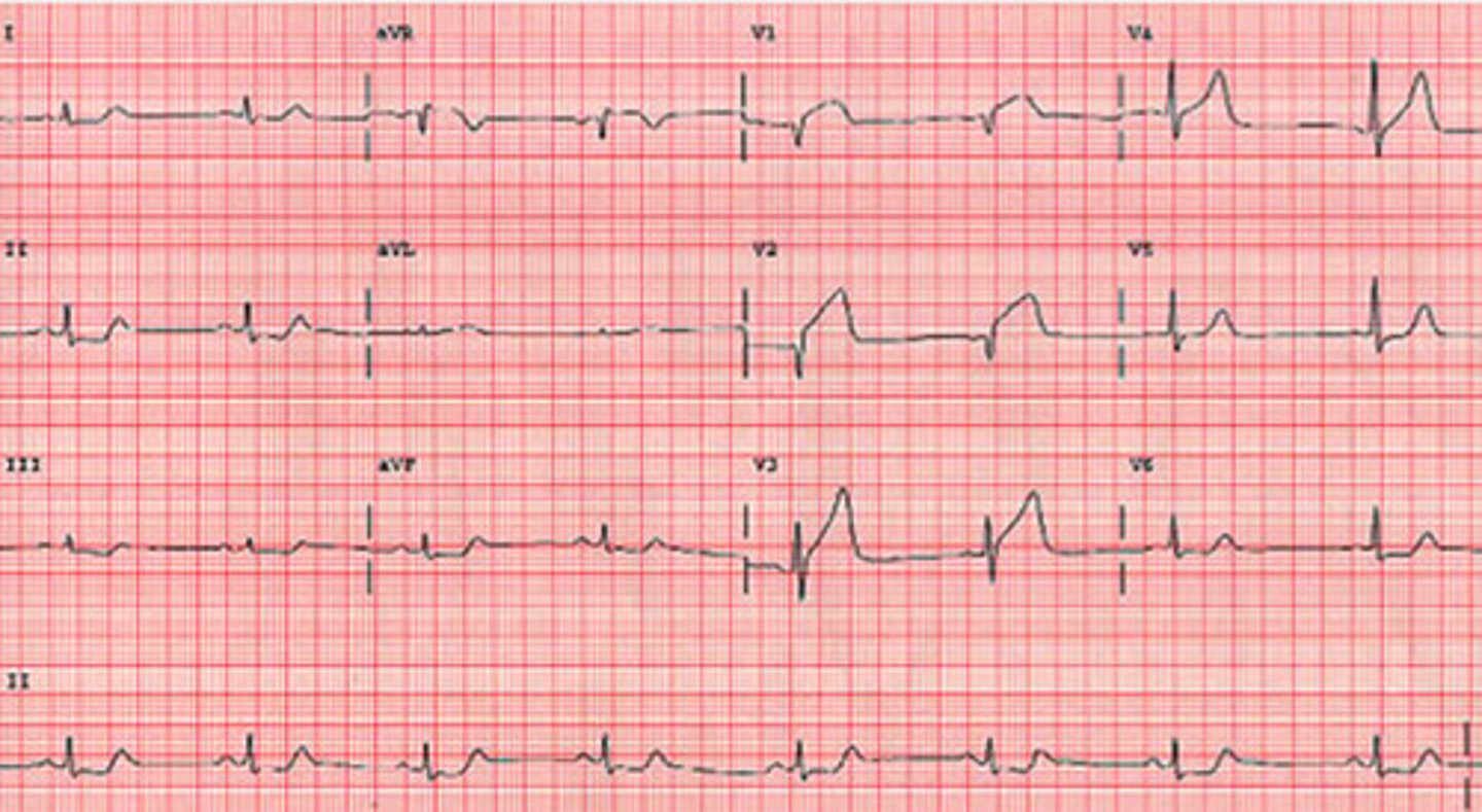<p>Anterior-septal STEMI</p>