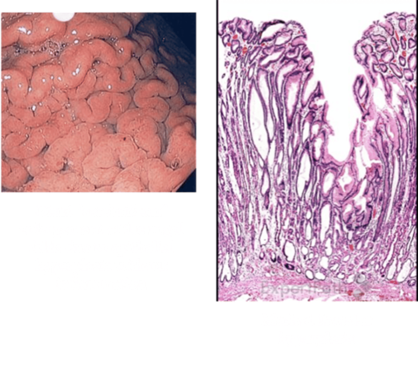 <p>Define Condition:</p><p>Hypertrophic gastropathy secondary to hyperplasia of mucus-producing cells​ in the stomach</p><p>-Hx:</p><p>&gt; Excessive secretion of TGF-Alpha</p><p>&gt; MEN Age 30-60 y/o</p><p>-Path:</p><p>&gt; Increased mucin production --&gt; leads to malabsorption of nutrients, electrolytes, and vitamins in the small bowel and protein loss (hypoproteinemic hypertrophic gastropathy​)</p><p>&gt; Little to no acid production</p><p>-Sx:</p><p>&gt; Diarrhea</p><p>&gt; Abdominal Pain</p><p>&gt; Nausea</p><p>&gt; Emesis</p><p>-PE:</p><p>&gt; Anorexia</p><p>&gt; Edema (d/t protein loss)</p><p>-Dx:</p><p>&gt; Labs:</p><p>&gt;&gt; Low Albumin</p><p>&gt;&gt; Increased TGF-Alpha</p><p>&gt; Endoscopy: Giant rugal folds in the body and fundus, but the antrum is generally spared</p><p>&gt; Biopsy: DIFFUSE HYPERPLASIA OF FOVEOLAR EPITHELIUM of the body and fundus and atrophy of parietal cells​</p>