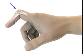 <p>What is the abnormality seen in the image below?</p>