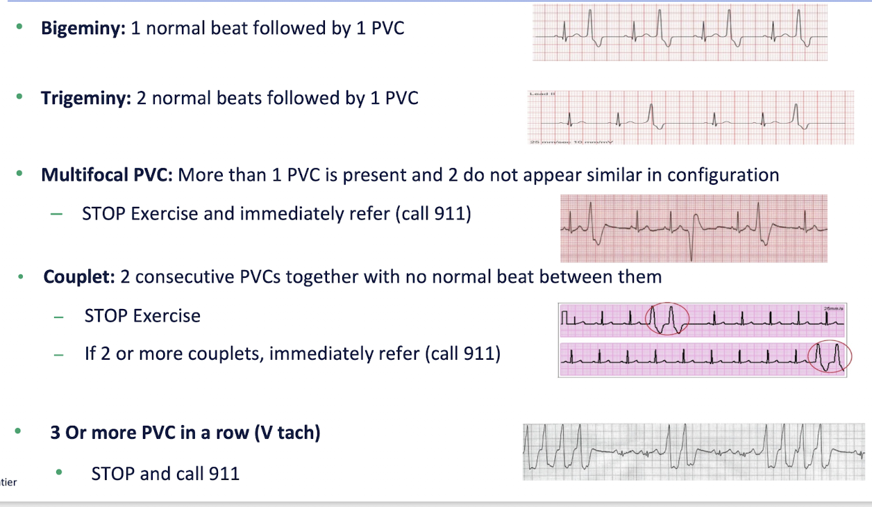 <ul><li><p>Bigeminy =</p><ul><li><p>1 normal beat followed by 1 PBC</p></li></ul></li><li><p>Trigeminy =</p><ul><li><p>2 normal beats followed by 1 PVC</p></li></ul></li><li><p>Multifocal PVC =</p><ul><li><p>More than 1 PVC is present and 2 do not appear in similar configuration</p><ul><li><p>STOP exercise and immediately refer (call 911)</p></li></ul></li></ul></li><li><p>Couplet =</p><ul><li><p>2 consecutive PVCs together with not normal beat between them</p><ul><li><p>STOP Exercise</p></li><li><p>If 2 or more couplets = Immediately refer (call 911)</p></li></ul></li></ul></li><li><p>3 or more PVC in a row = V Tach</p><ul><li><p>STOP and call 911</p></li></ul></li></ul><p></p>