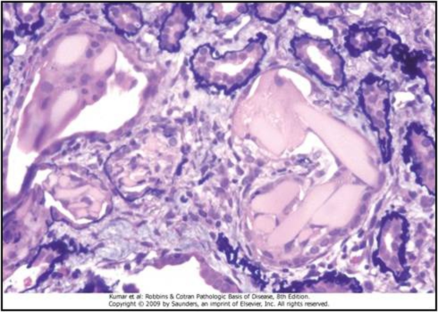 <p>most frequent form of renal damage inn multiple myeloma</p>