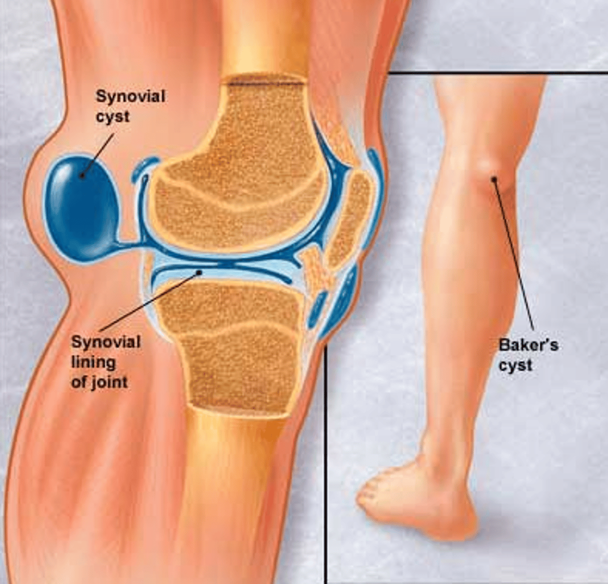 <p>What is a Baker's cyst?</p><p>- popliteal fluid collection in the gastrocnemius-semimembranous burse</p><p>- commonly communicates with the synovial space and is related to chronic joint disease</p>