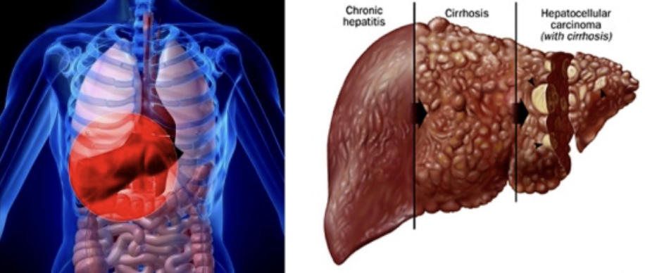 <ul><li><p><strong>EFFECT&nbsp;</strong></p><ul><li><p>Progressive, chronic inflammation from chronic hepatitis or alcoholism&nbsp;</p></li></ul></li><li><p><strong>CAUSE</strong></p><ul><li><p>Liver → Fatty, fibrous → Portal hypertension</p></li></ul></li></ul><p></p>