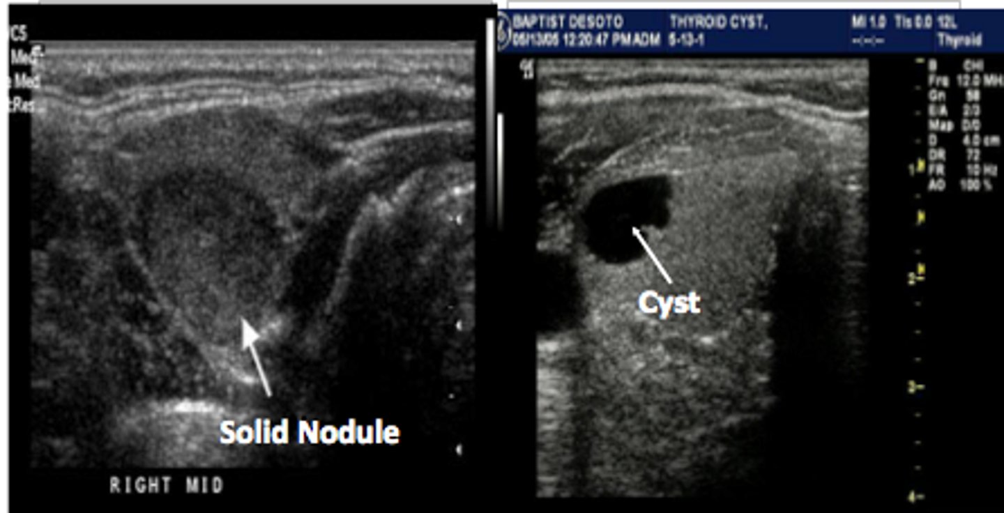 <p>Etiology</p><p>-Simple cyst</p><p>Clinical findings</p><p>-Asymptomatic</p><p>-Palpable neck mass</p><p>Sonographicfindings</p><p>-Anechoic mass</p><p>-Smooth wall margins</p><p>-Posterior acoustic enhancement</p><p>-May demonstrate internal debris </p>