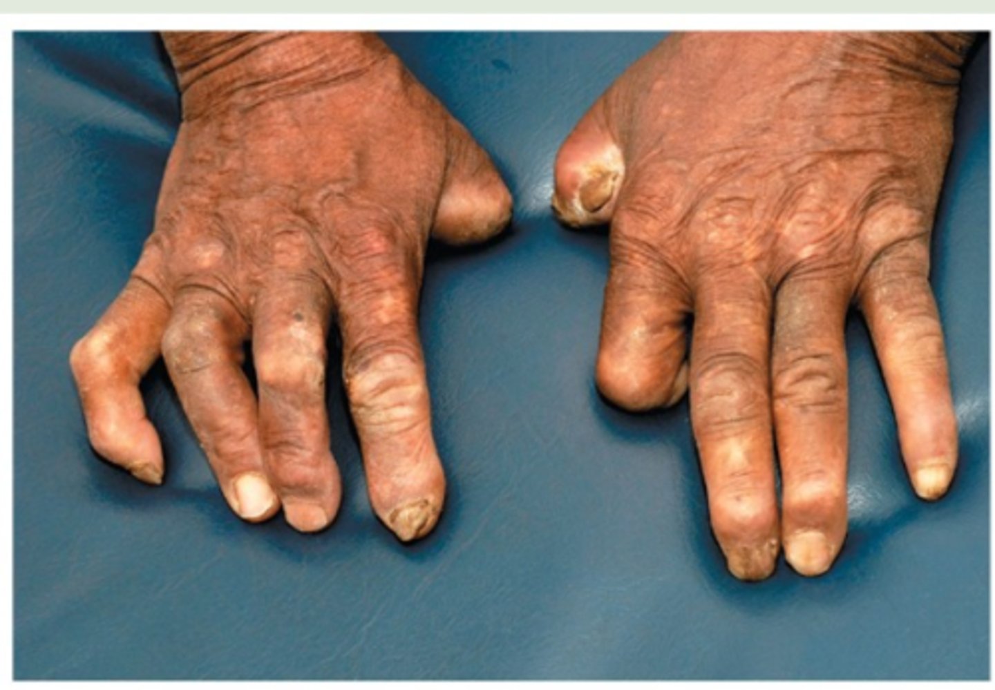 <p>Mycobacterium leprae; lepromatous form</p>