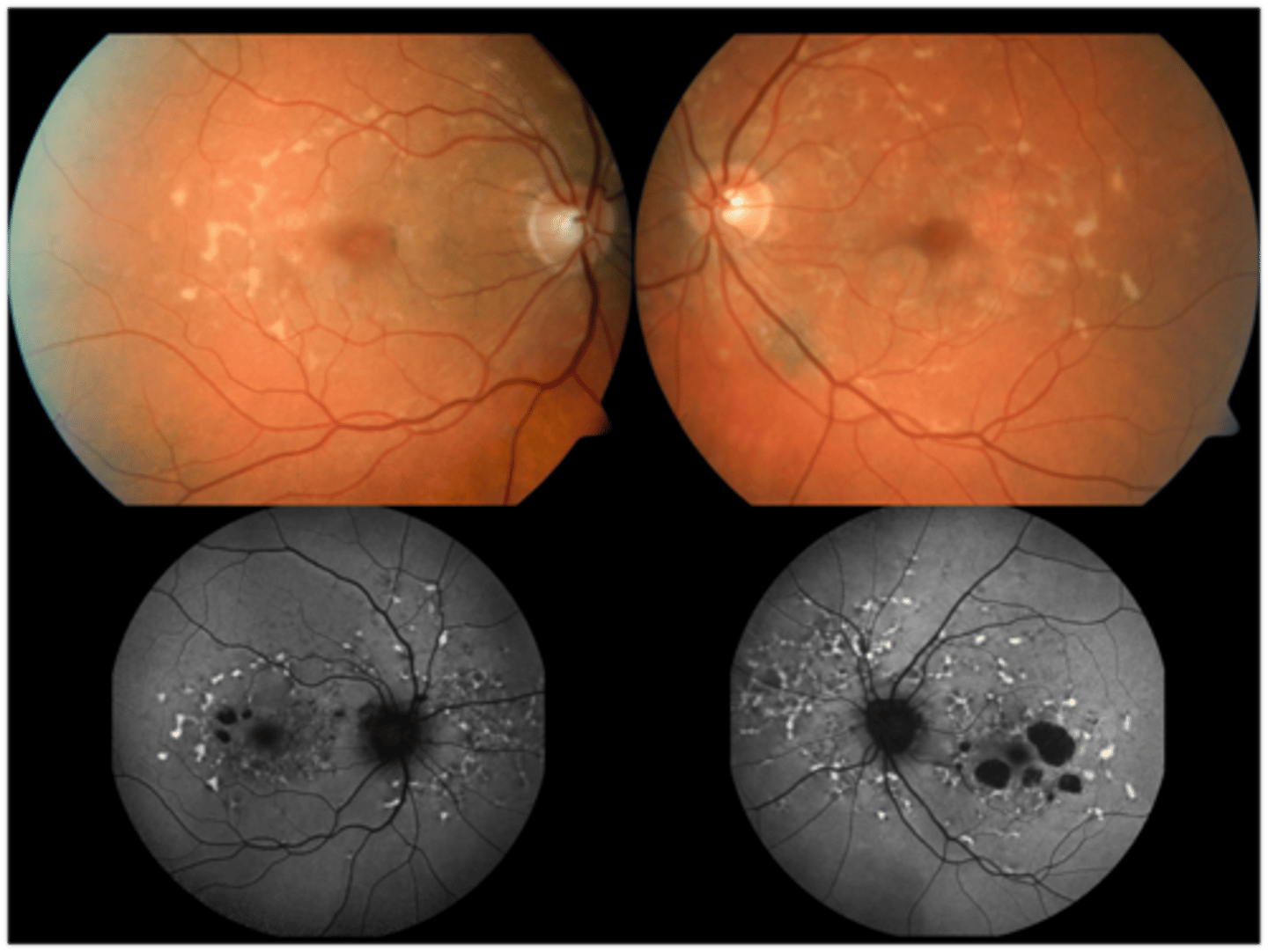 <p>hyperAF of flecks (increased lipofuscin)</p><p>hypoAF of RPE damage</p>