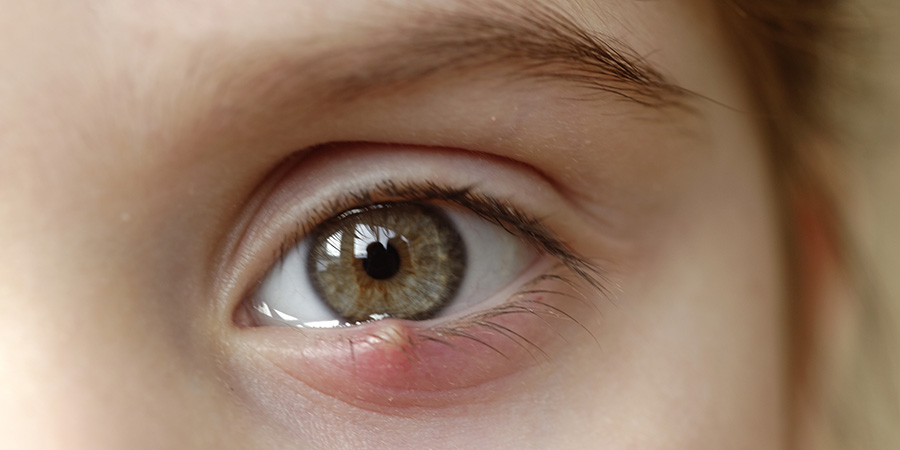 <p>(stye) tender lump on the lid margin</p>