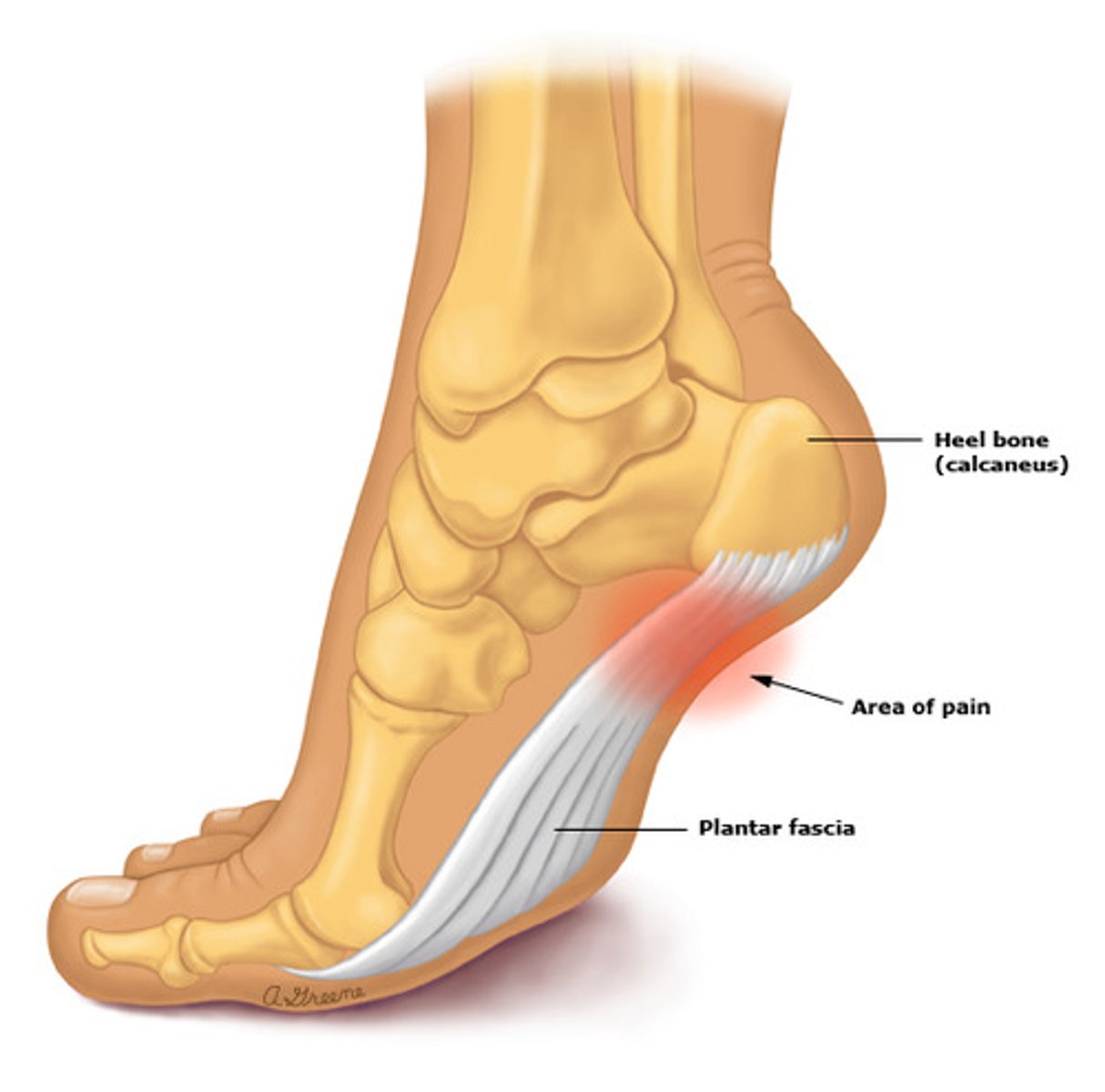 <p>plantar fasciitis → NSAIDs, ice, stretching (PT), steroid injections</p>