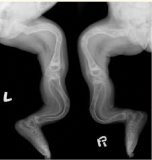 <ul><li><p>clinical manifestations </p></li><li><p><strong><em><u>skin</u></em></strong> biopsy for those w/ <strong><em><u>collagen</u></em></strong> deficits</p></li><li><p>ID <strong><em><u>collagen</u></em></strong> defect of mutation present</p></li><li><p>evidence of multiple old <strong><em><u>fractures</u></em></strong> and skeletal <strong><em><u>deformities</u></em></strong></p><ul><li><p>fractures usually in the <strong><em><u>shaft</u></em></strong> of the bone, not epiphysis</p></li></ul></li></ul>