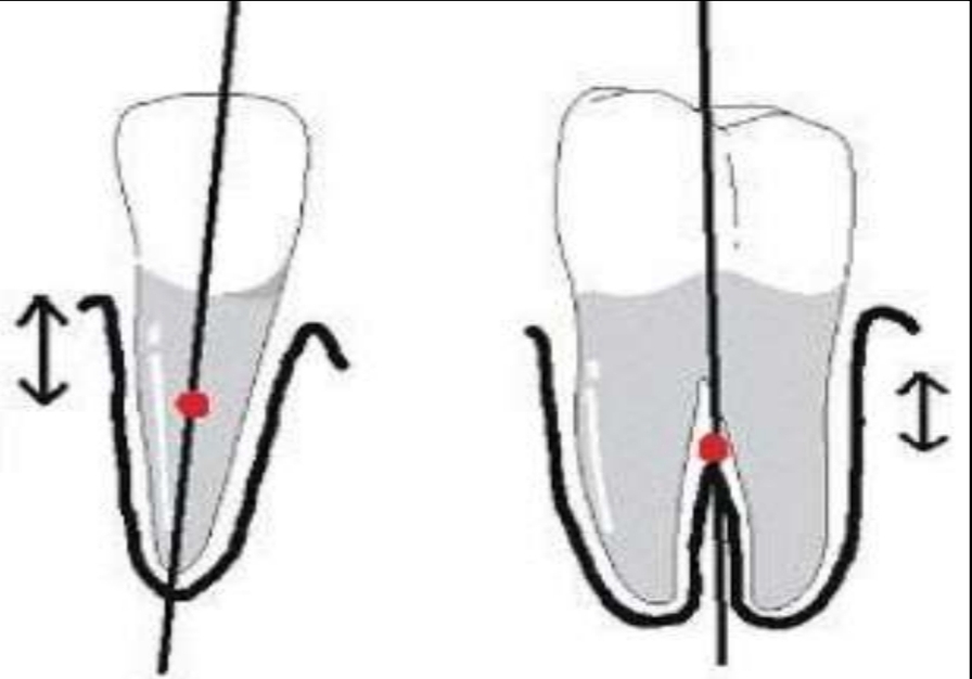 <p>Point at which a force can cause bodily movement (translation) of the tooth, without tipping or rotation.</p><p class="has-focus">Single root - ½ to 1/3 of length of (clinical) root</p><p class="has-focus">Multiradicular - 1 to 2 mm apical of furcation</p>