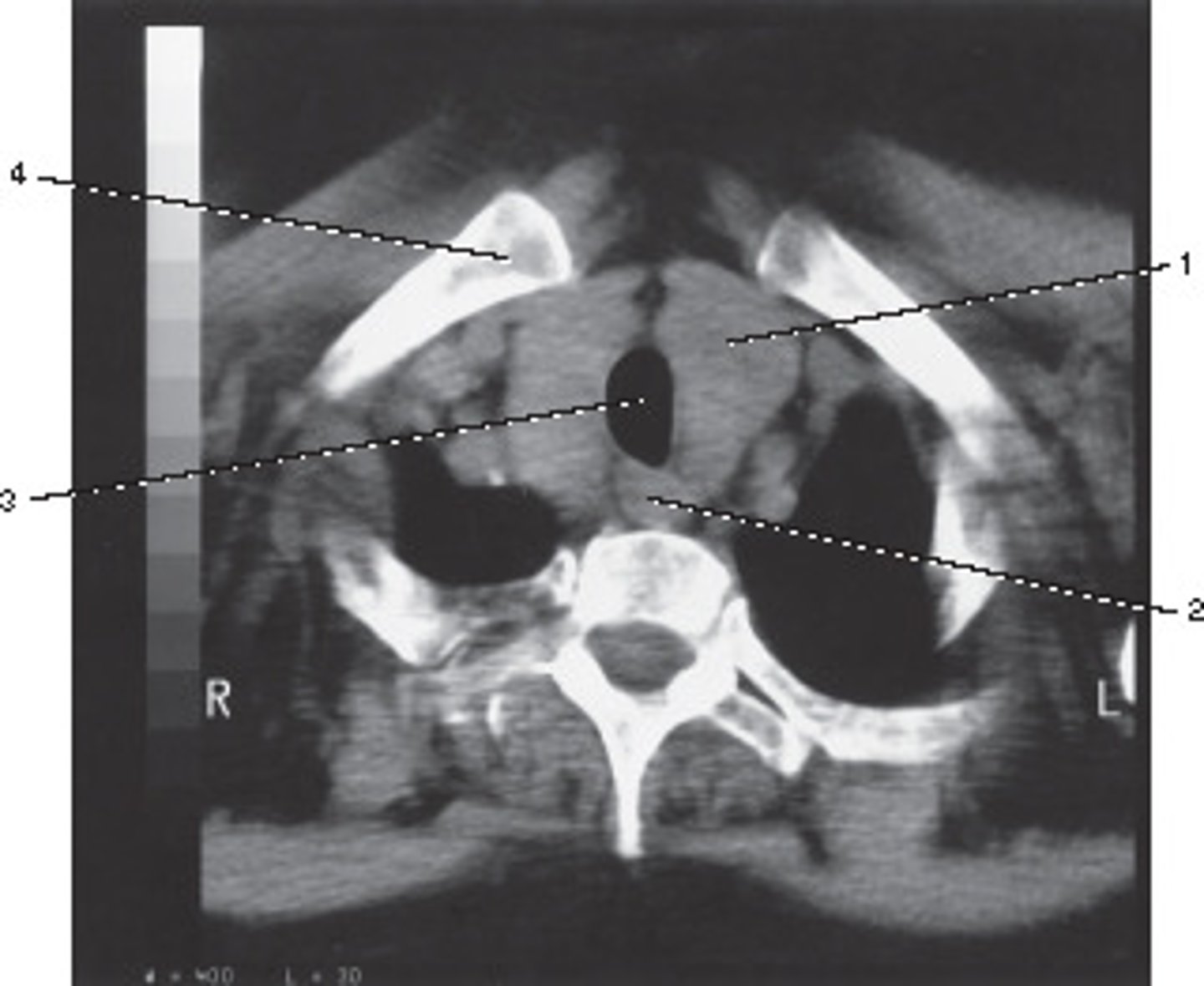 <p>What pathological process best describes the abnormal finding in this image?</p>