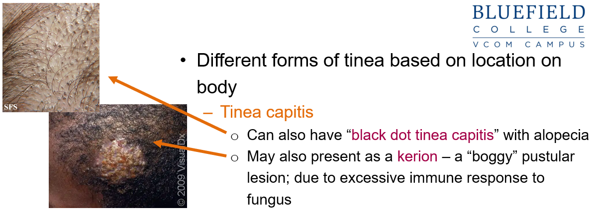 <p>Tinea capitis affects the <strong>scalp</strong> and may present as:</p><ul><li><p class=""><strong>Black dot tinea capitis</strong>: areas of <strong>alopecia</strong> with black dots</p></li><li><p class=""><strong>Kerion</strong>: a <strong>boggy, pustular lesion</strong> due to an intense immune response to the fungus</p></li></ul><p></p>
