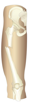 <p>what type of fracture is this?</p>