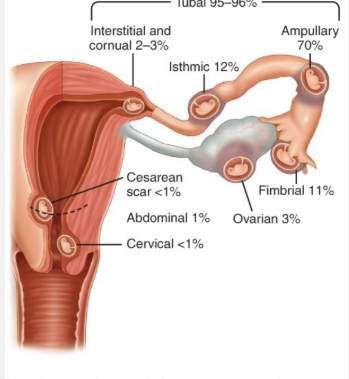 <p><strong>Ectopic Pregnancy: Background</strong></p><p>-Pregnancy in which the developing blastocyst implants at a site other than the endometrium of the uterine cavity, with 96% occurring in the<strong>&nbsp;</strong>_______ _____</p><p>-___________ from ectopic pregnancy is the leading cause of maternal mortality in the _____ trimester</p><p>-Risk Factors → previous ectopic pregnancy,&nbsp;tubal pathology (from ___), tubal sterilization, ___ use, and IVF</p>