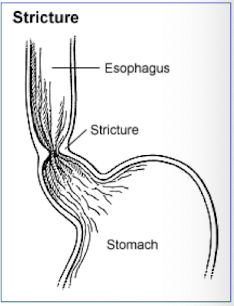 <p>strictures</p><p><em>most common 2<sup>o</sup> to anesthesia</em></p>