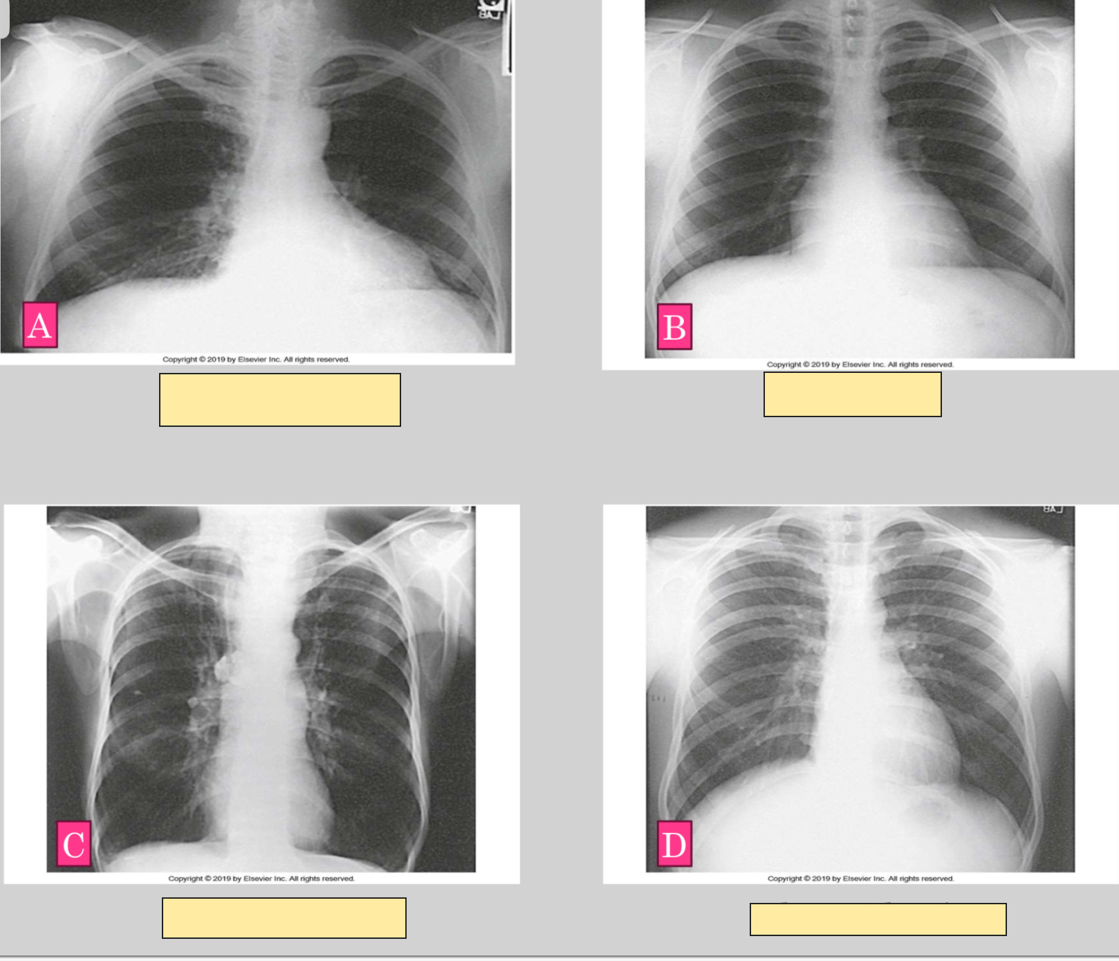 <p>What letter represents Hyposthenic body habitus?</p>