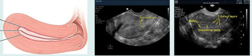 <p>what uterine phase is this (and endometrial thickness)?</p>