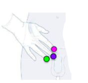 <p>What hernia is associated with what colour dot</p>