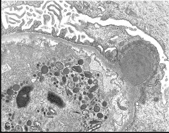 <p>Depósitos definidos, amorfos y electrodensos en la vertiente epitelial de la membrana a modo de <strong>JOROBAS </strong></p>
