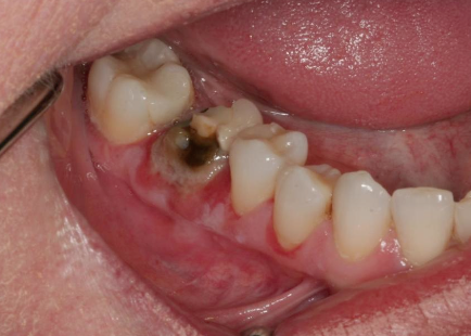 <p>What type of disease is Pemphigus Vulgaris?</p>