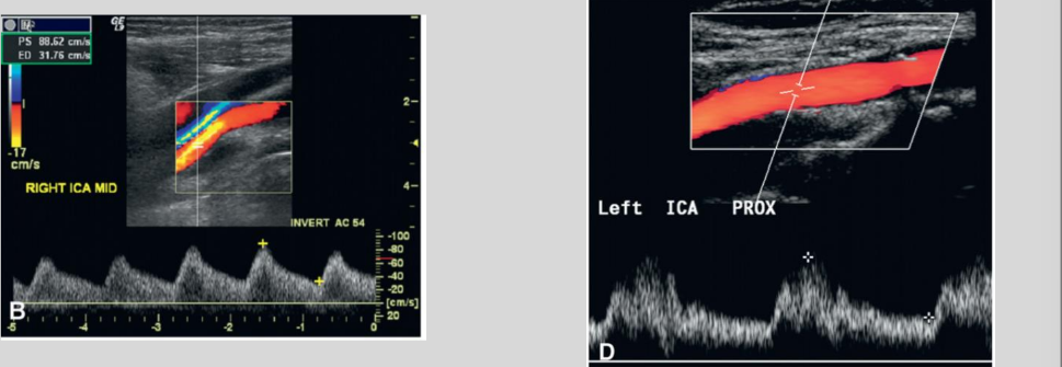<p>Aortic Valve Stenosis</p>