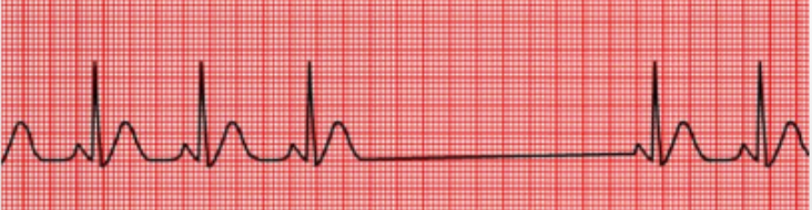 <p>Determine the sinus node arrhythmia: </p><p>Sinus node stops resulting in a missing beat. Rhythm is irregular</p>