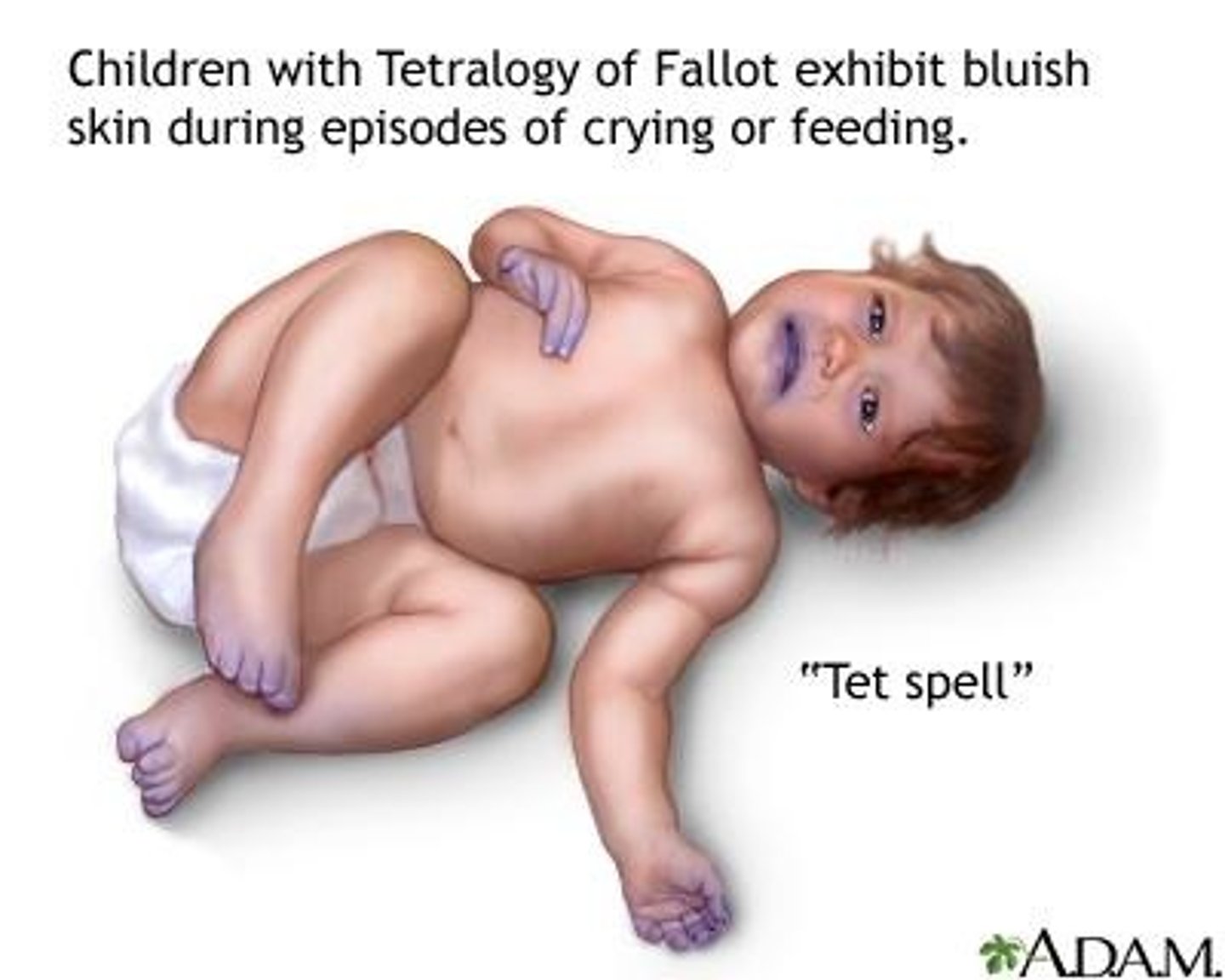 <p>sudden cyanosis, dyspnea, irritability</p>