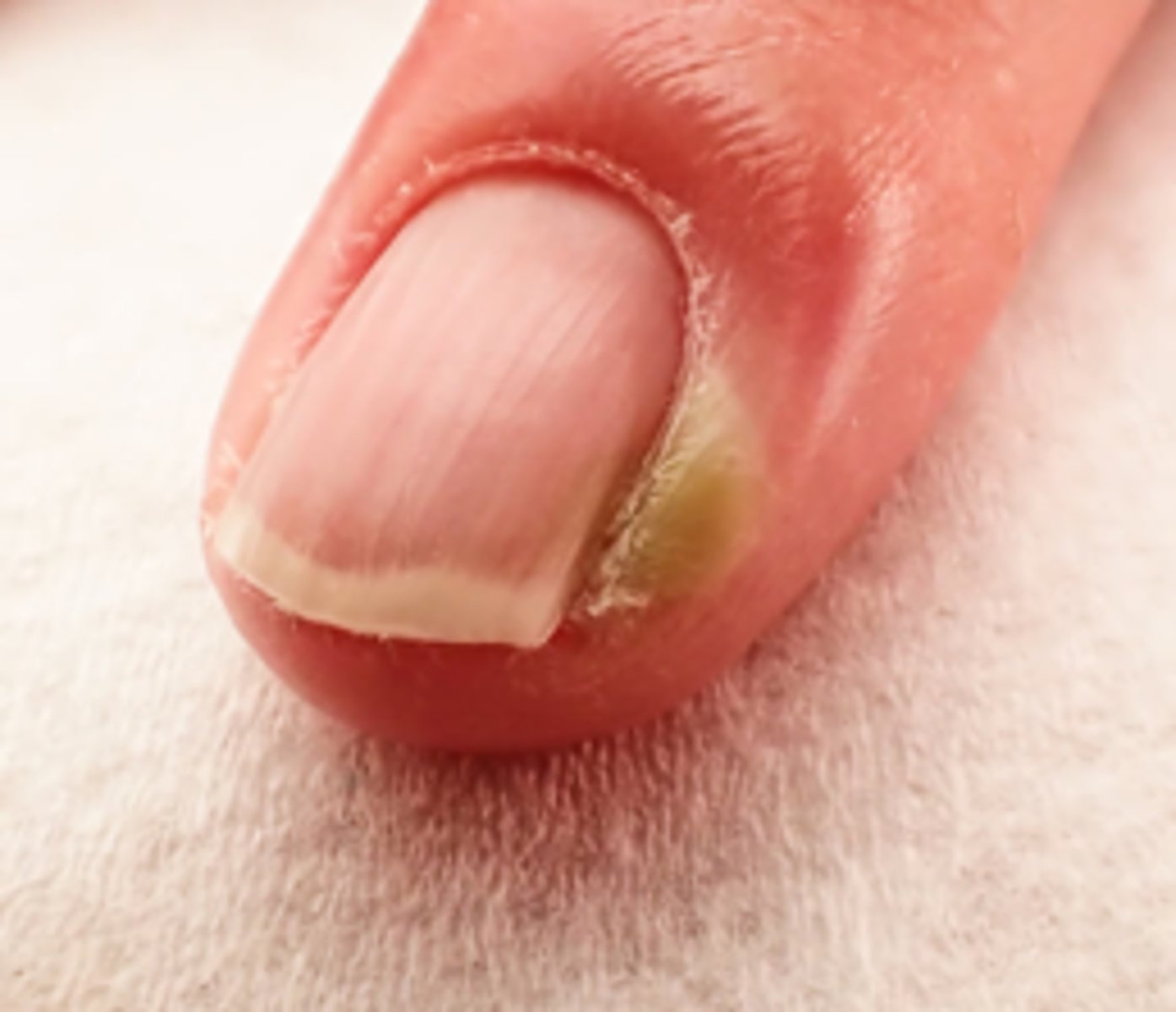 <p>◦Inflammation and infection of the soft tissue of the nail (paronychia area) around the proximal and lateral nail folds</p><p>◦Folds become erythematous, swollen, tender (infected)</p>