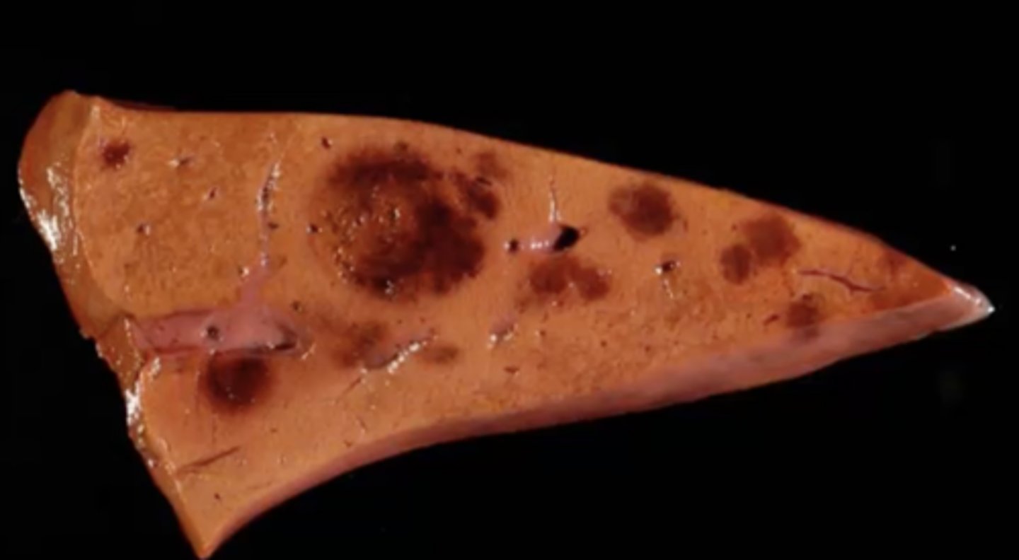<p>What has caused this gross appearance of this liver?</p>