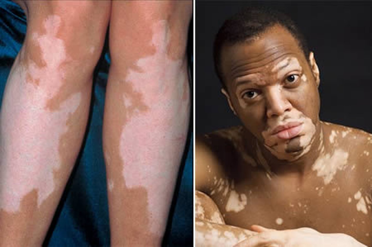 <p>Vitiligo</p>