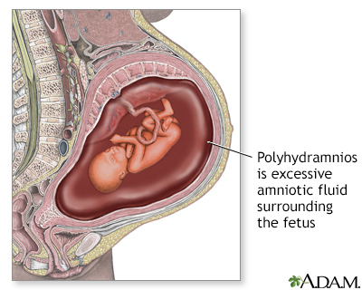 <p><strong>Polyhydramnios</strong> is <strong>excessive amniotic fluid</strong>, commonly caused by:</p><ol><li><p><strong>Birth defects</strong> involving the <strong>GI or CNS</strong> that impair <strong>fetal swallowing</strong> (most common)</p></li><li><p><strong>Maternal diabetes</strong></p></li><li><p><strong>Idiopathic causes</strong></p></li></ol><p></p>