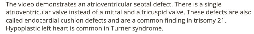 <p>d) trisomy 21</p>