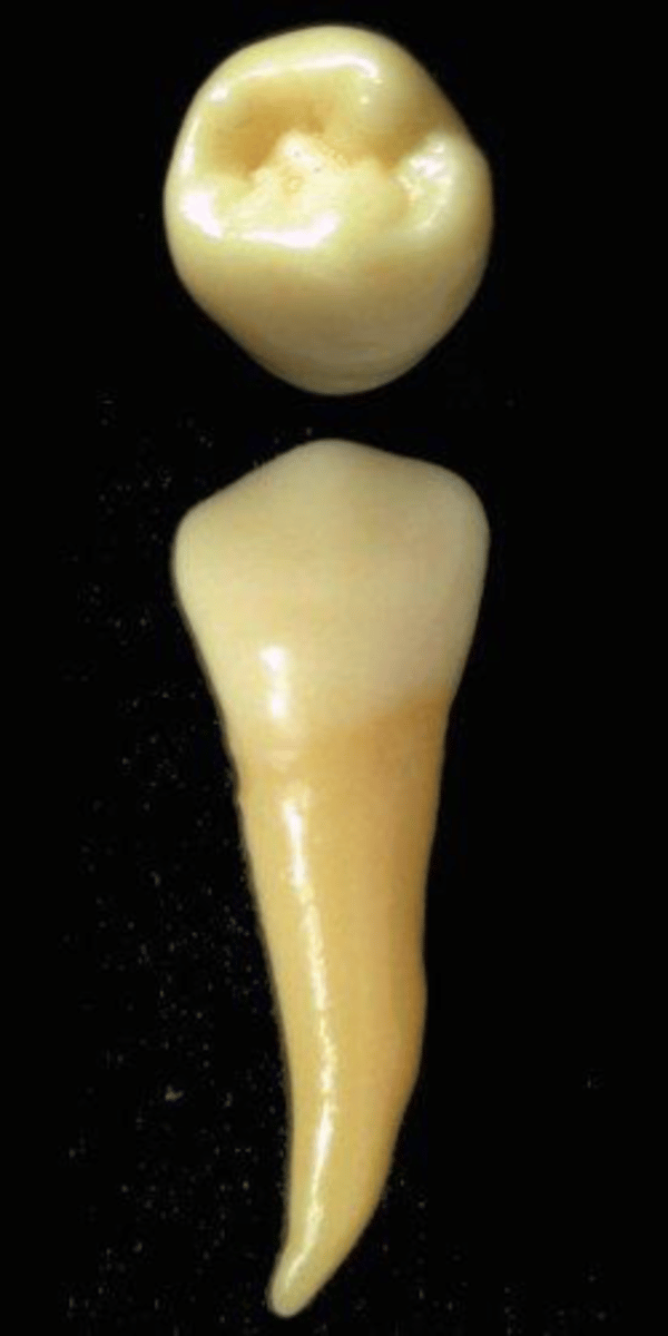<p>what tooth is this &amp; why?</p>