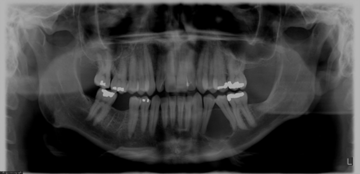 <p>ID the cyst (tooth is vital)</p>