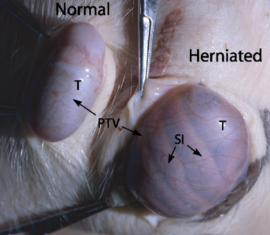 <p>common condition in which the small intestine pushes through the inguinal canal into the scrotum.</p>