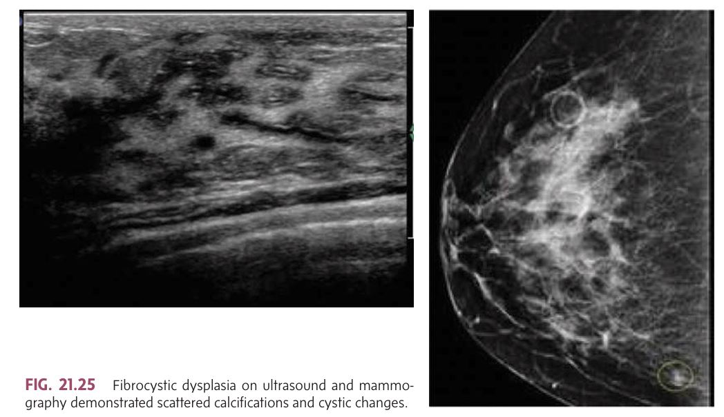 <p></p><ul><li><p class=""><strong><mark data-color="yellow" style="background-color: yellow; color: inherit">Most common cause of breast masses in premenopausal women.</mark></strong></p></li><li><p class=""><strong>Symptoms:</strong></p><ul><li><p class="">Pain (mastodynia), especially premenstrual.</p></li><li><p class="">Swollen, heavy breasts.</p></li><li><p class="">Dark brown or green nipple discharge.</p></li><li><p class="">Discomfort under the arms.</p></li><li><p class="">Both breasts are often equally affected.</p></li></ul></li><li><p class=""><strong>Imaging Findings</strong>:</p><ul><li><p class=""><strong>Mammogram</strong>: Diffuse benign microcalcifications and round masses.</p></li><li><p class=""><strong>Ultrasound</strong>: Scattered calcifications and cystic changes (simple, complicated, or clustered cysts).</p></li></ul></li><li><p class=""><strong>Stages of Fibrocystic Changes</strong>:</p><ol><li><p class=""><strong>Mastodynia (Pain)</strong> – Occurs in younger women, usually before menstruation.</p></li><li><p class=""><strong>Adenosis</strong> – Common in women aged 25 to 40; can cause painful, lumpy breasts and nipple discharge.</p></li><li><p class=""><strong>Late-stage Cystic Disease</strong> – In women aged 35-55, presents with larger cysts, increased pain, and palpable lumps.</p></li></ol></li><li><p class=""><strong>Pathology</strong>: Includes apocrine metaplasia, fibrosis, epithelial ductal hyperplasia, and sclerosing adenosis. It's important that biopsy findings correlate with imaging and clinical symptoms.</p></li></ul><p></p>