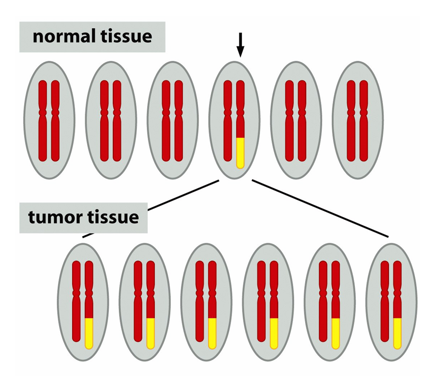 <p>B-call tumors create single antibodies for specific antigens and therefore they would produce many different antibodies if they arose from multiple, individually transformed cellls</p><p>they producde a single antigen</p><p></p><p>and from chromosomal lesion analysis which had all cells of the same tumour presenting with the same legions</p><p>Philadelphia(Ph) chromosomes found in chronic myeloid leukamia and results in the translocation of BCR gene and its promoter upstream of the Abl gene to create new fusion gene (Bcr-Abl) with the protein product creating an increase in kinase acitivty</p>