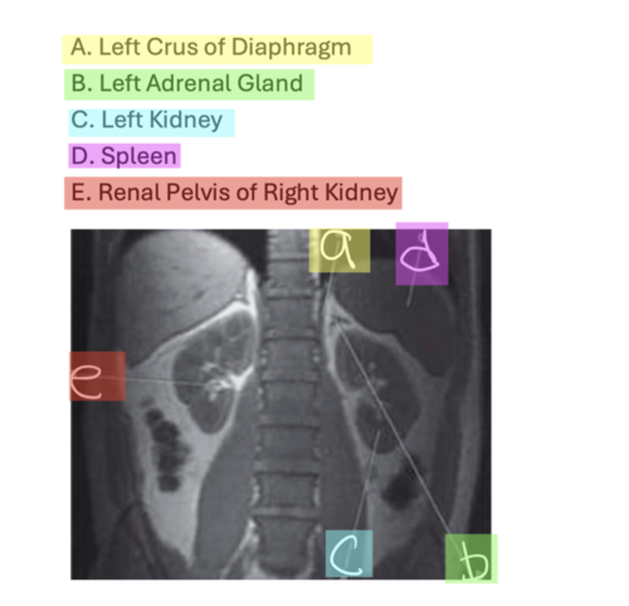 <p>A. Left Crus of Diaphragm</p><p>B. Left Adrenal Gland</p><p>C. Left Kidney</p><p>D. Spleen</p><p>E. Renal Pelvis of Right Kidney</p>