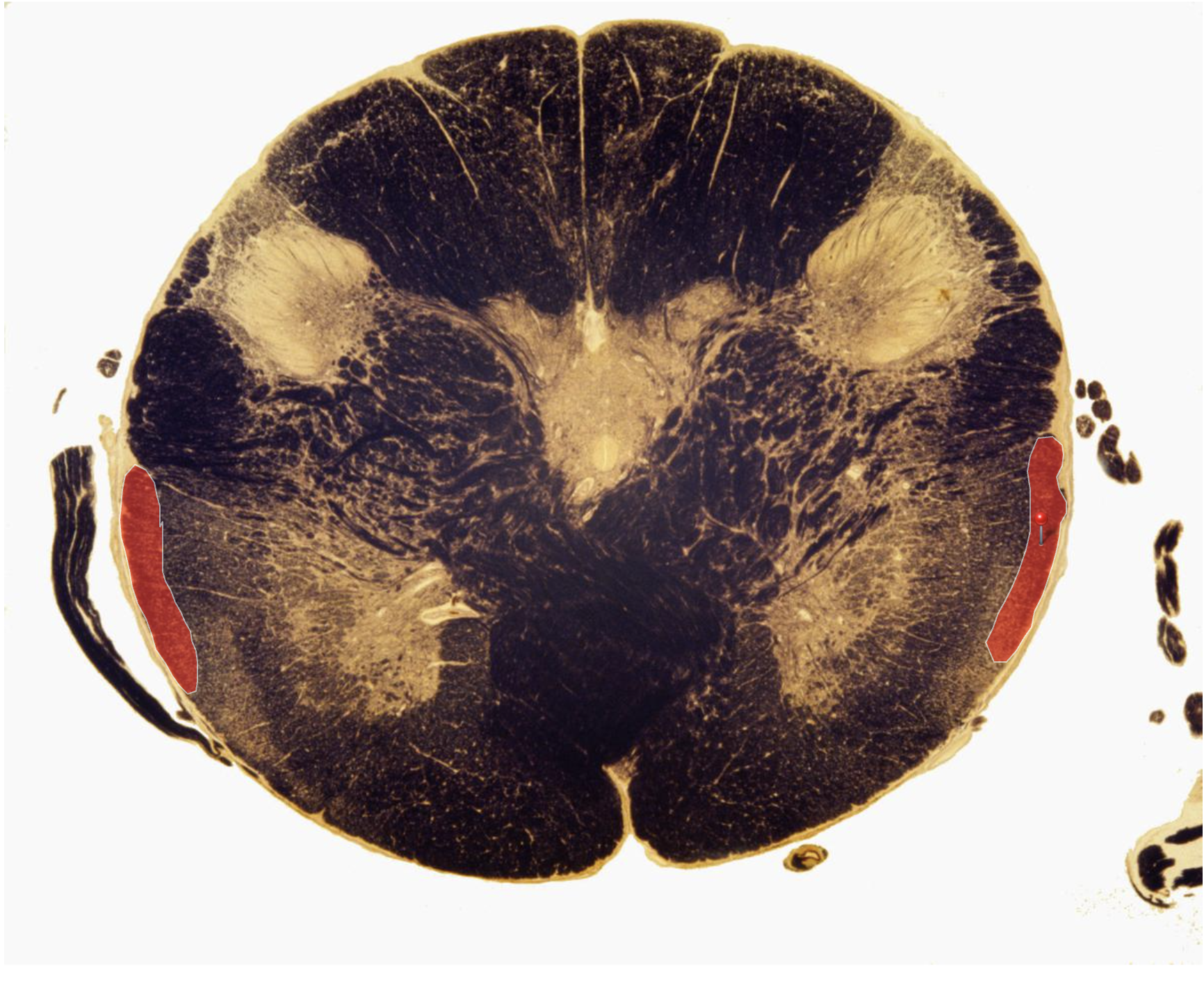 <p>Ventral Spinocerebellar Tract (double-crossed, functionally ipsilateral, enters via superior peduncle)</p><p>Transmits <u>Wholistic</u> <strong>lower limb proprioception </strong></p>