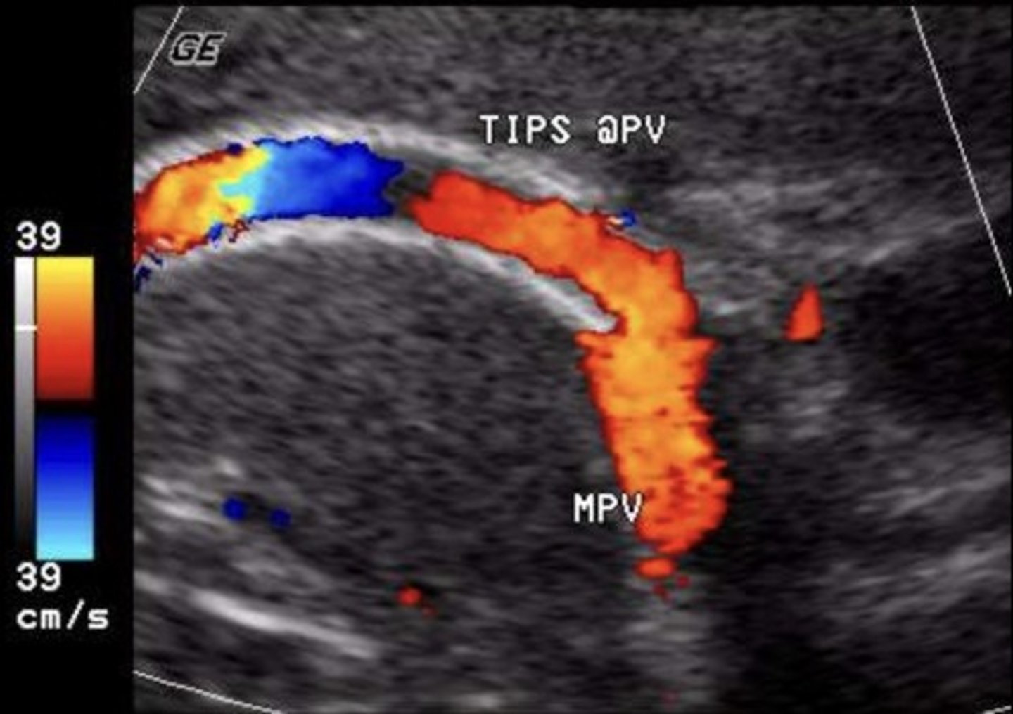<p>No focal aliasing</p><p>Hepatofugal flow in portal veins beyond stent</p>