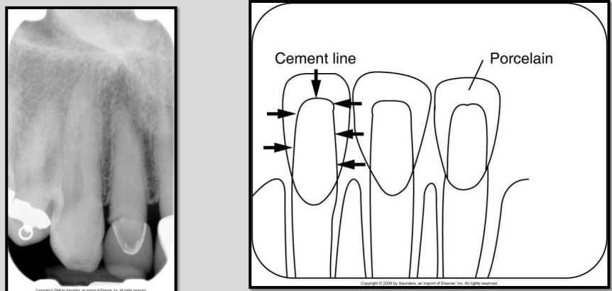 <p>Thin radiopaque line outlining the prepared tooth that represents cement</p><ul><li><p>cement may be seen through the slightly radiopaque porcelain crown</p></li></ul><p></p>