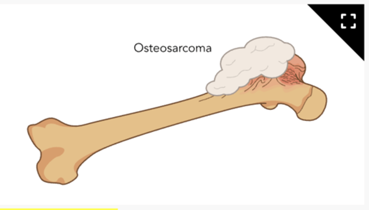 <p>cancer of the bone</p><p>-creates osteoids in the bone</p>