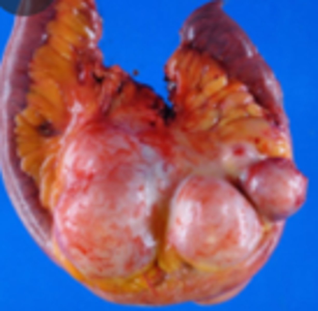<p>Jejunum and Ileum</p>