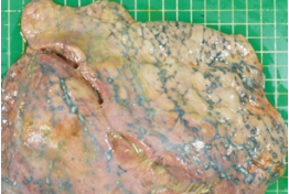 <p>fibrin, adhesions, thickened pleura </p>