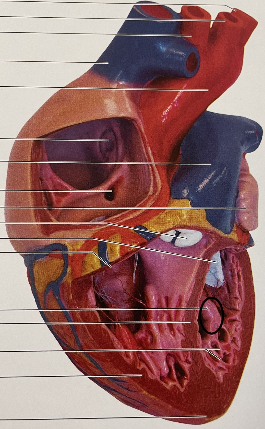 nipple-like; in ventricles