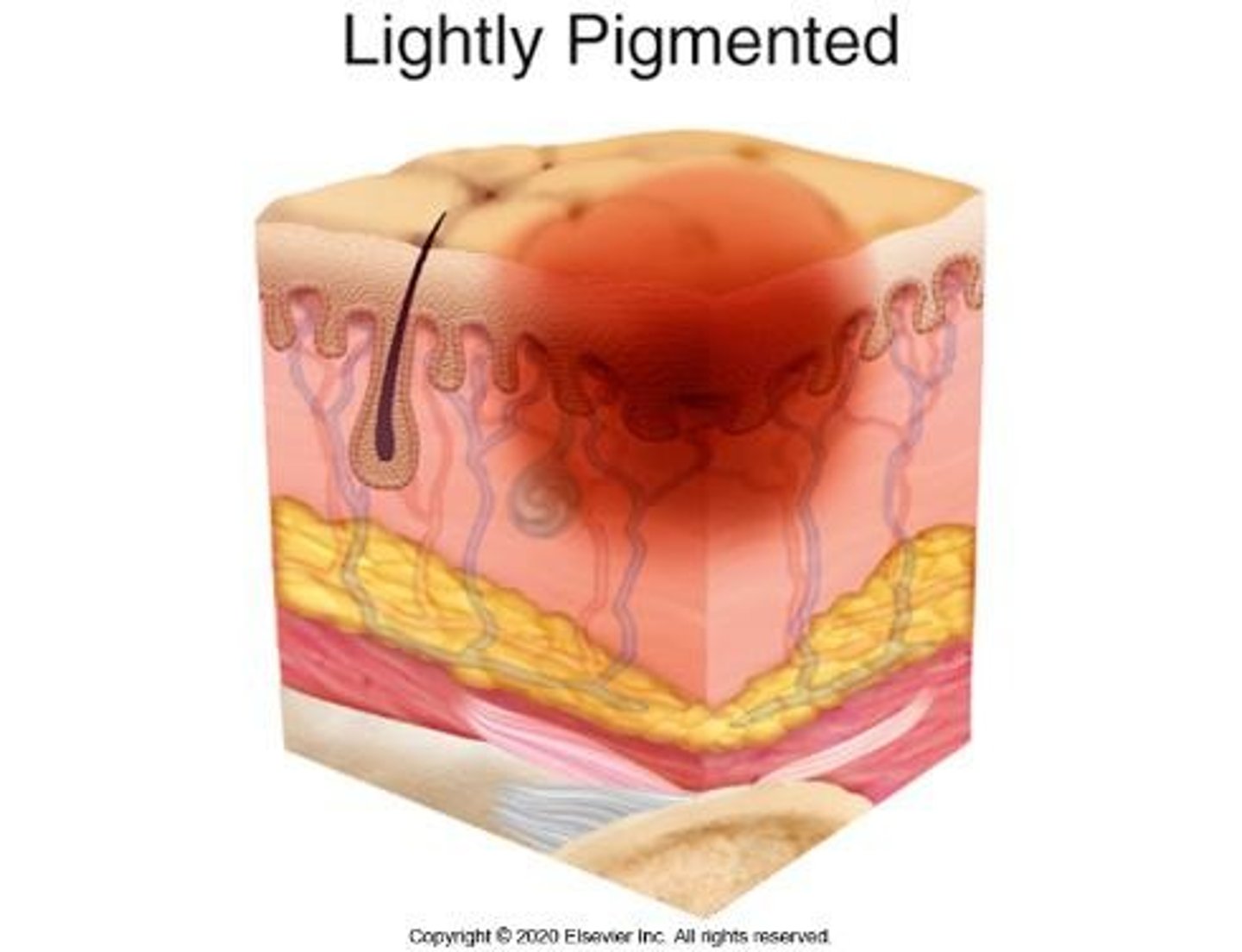 <p>Non-blanchable erythema of intact skin; skin is intact.</p>